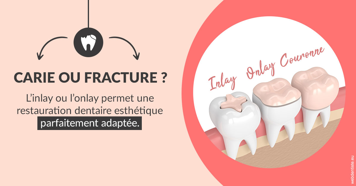 https://dr-bensoussan-sylvie.chirurgiens-dentistes.fr/T2 2023 - Carie ou fracture 2