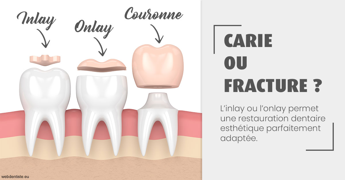 https://dr-bensoussan-sylvie.chirurgiens-dentistes.fr/T2 2023 - Carie ou fracture 1