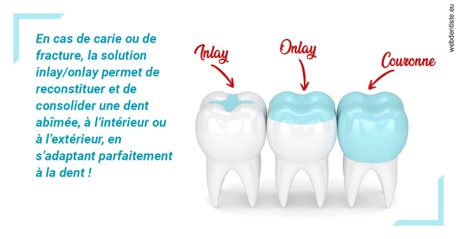 https://dr-bensoussan-sylvie.chirurgiens-dentistes.fr/L'INLAY ou l'ONLAY