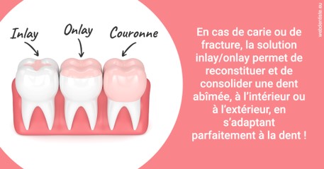 https://dr-bensoussan-sylvie.chirurgiens-dentistes.fr/L'INLAY ou l'ONLAY 2