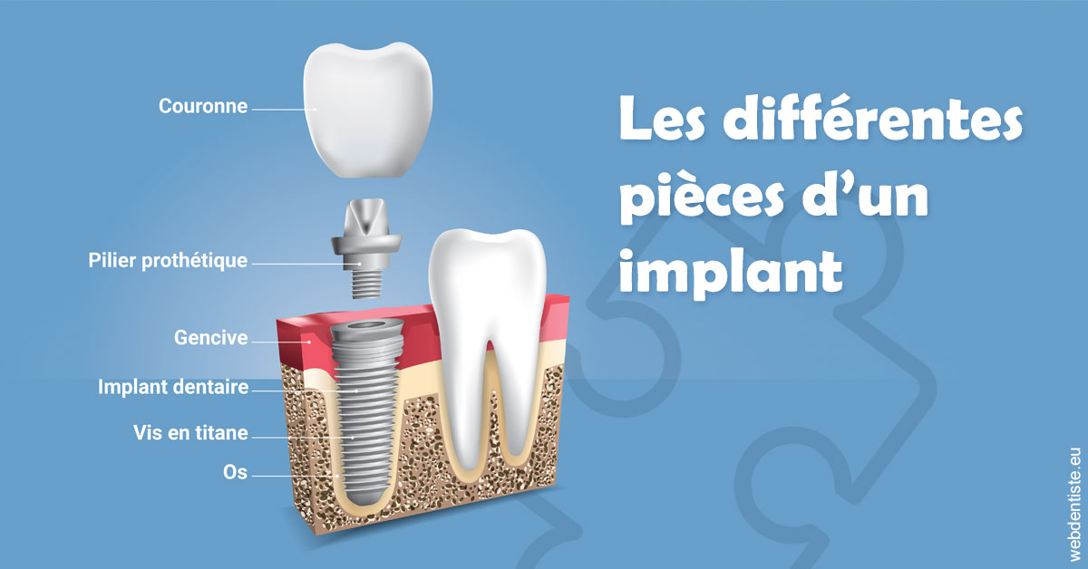 https://dr-bensoussan-sylvie.chirurgiens-dentistes.fr/Les différentes pièces d’un implant 1