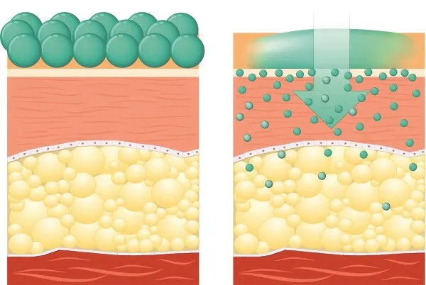 Acide hyaluronique